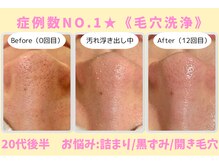 ウル 下北沢(Ulu)/韓国式３D毛穴洗浄