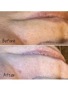 アルディート(Ardito)/WAX脱毛