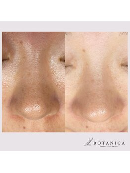 ボタニカ(BOTANICA)/毛穴レス肌!韓国式毛穴洗浄