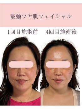 シンナリ(Shinnari)/最強ツヤ肌フェイシャル