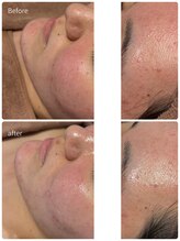 ウィハナ(wehana)&nbsp;ハーブ ピーリング