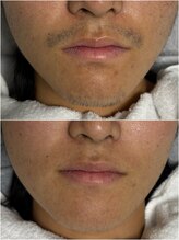 ルシャトン(Le Chaton)/ヒゲ脱毛