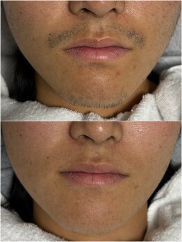 ルシャトン(Le Chaton)/ヒゲ脱毛