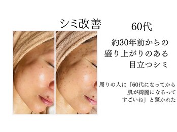 シャルナ(charna)/シミ改善