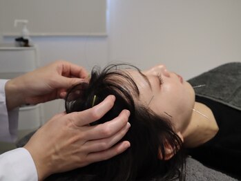 ビーロイヤル(B-ROYAL)/頭皮鍼も!眼精疲労の原因撃退!