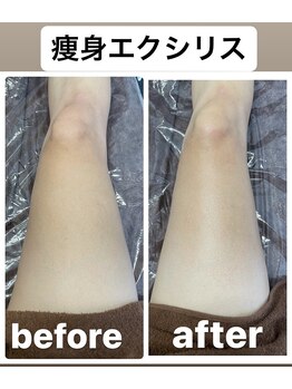 リベル(Liber)/痩身エクシリスで足引き締め