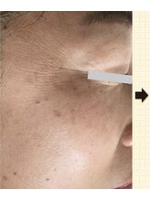 ノットノット 自由が丘(Not Knot)/１.リアボーテ AC 施術前