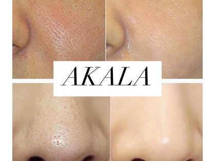 アカラ(AKALA)の写真