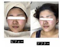 メリアミーゴ(Meli amigo)/20代　毛穴洗浄