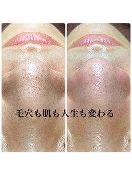 ピエル 北千住店(PIEL)/毛穴も肌も人生も変わる