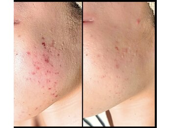 エリュクス(et Luxe)/長年のニキビや凹凸のお悩みも！