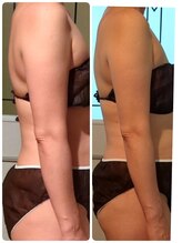 ヨサパーク アカーシャ(YOSA PARK AKASHA)/二の腕周りのたるみに