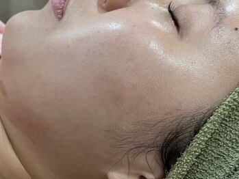 スター(Star)の写真/【本格肌質改善】エイジングケアに特化した本格派サロン☆疲れたお肌を改善☆憧れの美白艶玉へ変身!