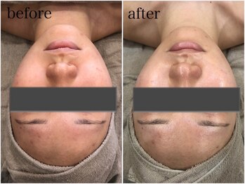 ナチュラル シャイン(NATURAL SHINE)/REVI ハープピーリング1回