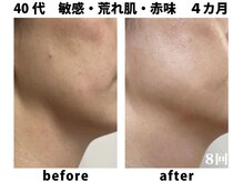 エーキューミチカ 美肌室(AQ michica)/◆赤味、ヒリヒリ解消！透明感♪