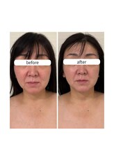 スリーメイ(3mey)/口横もたつき輪郭たるみ改善