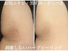 世界的特許取得の厳選された国産ハーブを使用★お顔/お尻/背中