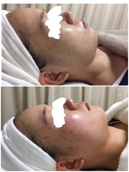 ビズビズ 天王寺店(bisebise)/ニキビ/毛穴開き黒ずみ角栓詰り