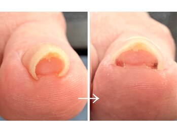 巻き爪フットケアサロン 神楽坂/アクリル×プレート巻き爪ケア