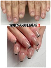 スマイルニコ(smile nico)/深爪矯正　長さ出し有ワンカラー