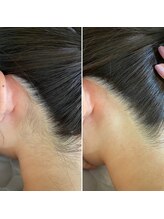 インベスト(INVEST)/うなじ脱毛