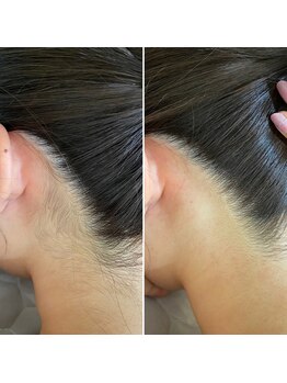 インベスト(INVEST)/うなじ脱毛