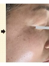 ノットノット 自由が丘(Not Knot)/２.リアボーテ AC 施術1回後