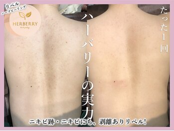 アッシュ 梅田(H)/ハーブピーリング専門Hアッシュ