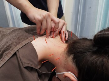 南行徳ひびき整骨院の写真/【肩こりや腰痛に悩む方に最適な鍼メニューがオススメ】深部の凝りにアプローチ◎自律神経を整え免疫UP！