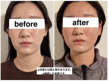 グリーン鍼灸整体院(green鍼灸整体院)/美容鍼