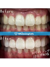 ホワイトニングカフェ 綾瀬店(WhiteningCafe)/◎歯のホワイトニング施術写真◎