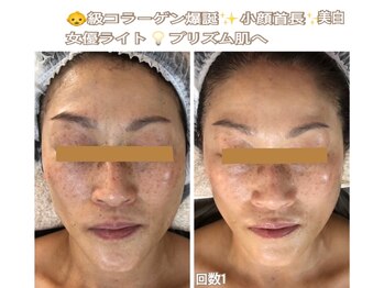 アルページュ(Arpege)/中下顔面短縮♪童顔色白スッピン