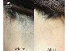 トリンテ バイ フェース(TRINTE by FAITH)/【光効果】うなじ9回(4週間隔）