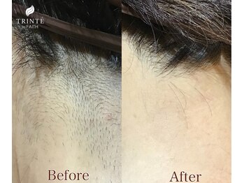 トリンテ バイ フェース(TRINTE by FAITH)/【光効果】うなじ9回(4週間隔）