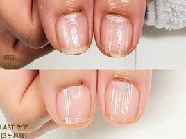 地爪育成｜3ヶ月後変化