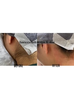 ファウラ(faura:)/うなじwax+光脱毛【ダブル脱毛】
