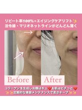 フェミニー(Feminy)/法令線、マリオネットラインに