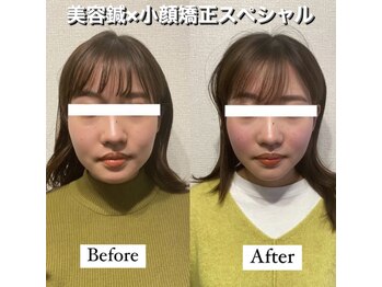 ハリカ 大阪心斎橋店(HARIKA)/定番人気の美容鍼×小顔矯正