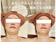 クロレ 浦和店(CLORE)の雰囲気（たった１回のハイパーナイフ施術で二重アゴスッキリ解消エステ）