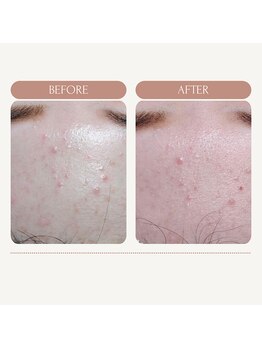 エミナル バイ ニコドット(Eminal by nico.)/肌トラブルがずっとのお悩み