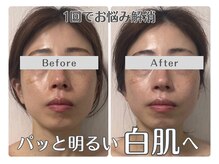 ルリアン(Lurian)/エステ1回でのBefore→After