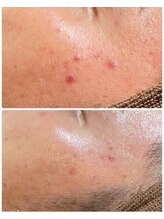 ルタンリッシュオム(Lutan Riche hom)/ハーブピーリングの力