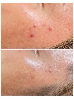 ルタンリッシュオム(Lutan Riche hom)/ハーブピーリングの力