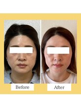 クローバー(clover)/【before/after】施術１回目翌日