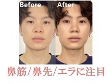 ラプリシュシュ 岡山店(Raplit)/隆鼻＋輪郭矯正40分10回