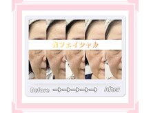 クレア 半田店(Crea)/光フェイシャル