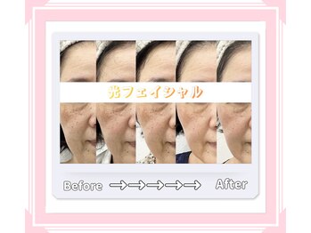 クレア 半田店(Crea)/光フェイシャル