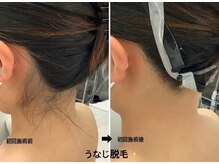 メディカルサロンドオフ 堺東店(medical salon de off)/うなじ襟足脱毛♪
