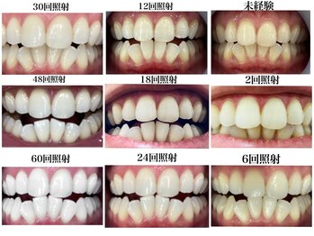 ラブホワイトニング 池袋店(LOVEホワイトニング)/デラックスコースホワイトニング