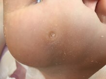 ビサンテ サロン/魚の目・たこに先進・角質ケア後